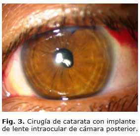 Lente intraocular 2025 de camara anterior