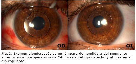raqueta Banquete terrorista Corrección de la alta miopía con implante de lente fáquica ACR-128 |  Cárdenas Díaz | Revista Cubana de Oftalmología
